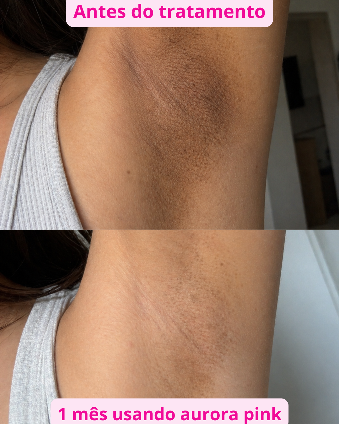 Antes e Depois Axilas Aurora Pink