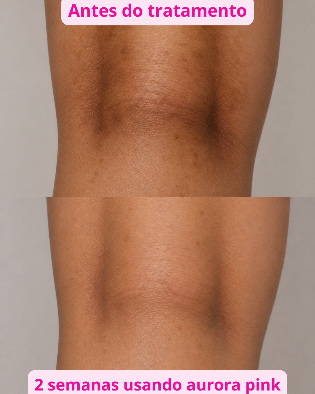Antes e Depois Joelhos Aurora Pink