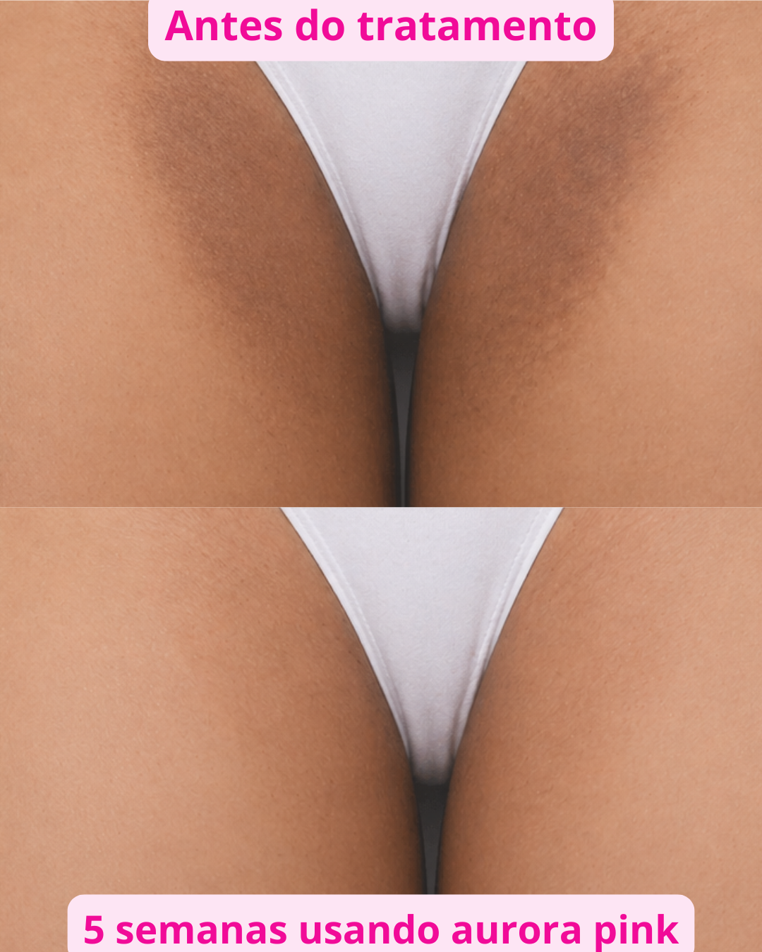 Antes e Depois Virilha Aurora Pink